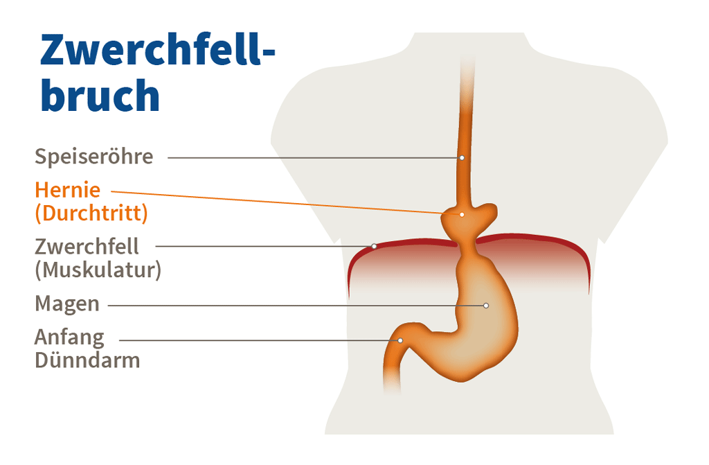 zwerchfellbruch op ja oder nein